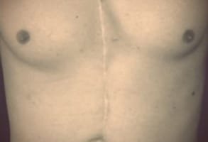 Foto von der vernarbten Brust des Global Seducer Sebastian Harris